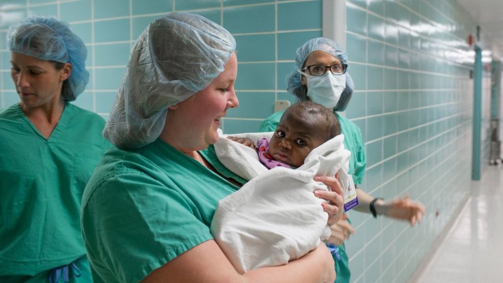 Risky operation removes parasitic twin from baby FuseForNews